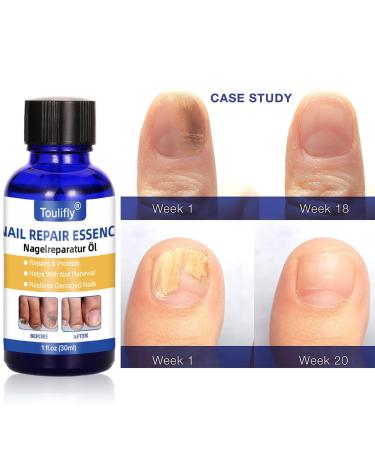 Premium Nail Care & Treatment | Repair Broken & Discolored Nails with Nourishing Nail Oil & Serum for Healthy Hands & Feet - Buy Online on GoSupps.com