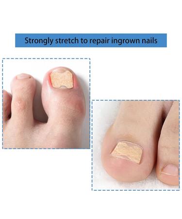 Fitmedify Toenail Correction Patch - 60 Pcs for Ingrown Toenail Prevention - Buy Online on GoSupps.com