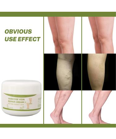 Natural Varicose Veins Cream - Strong Penetration & Safe Ingredients | Effective Relief Worldwide - Buy Online on GoSupps.com