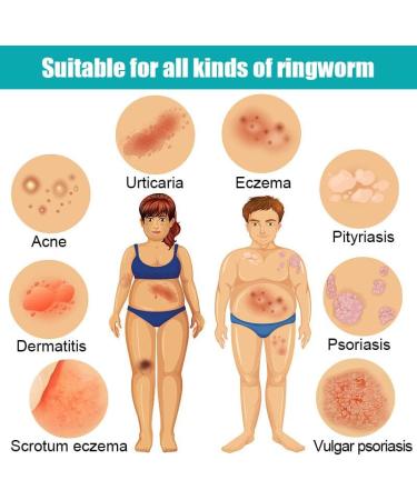 Eczema Honey Skin Care - Natural Chinese Herbal Anti-Itch Cream (Pack of 2) - Buy Online on GoSupps.com