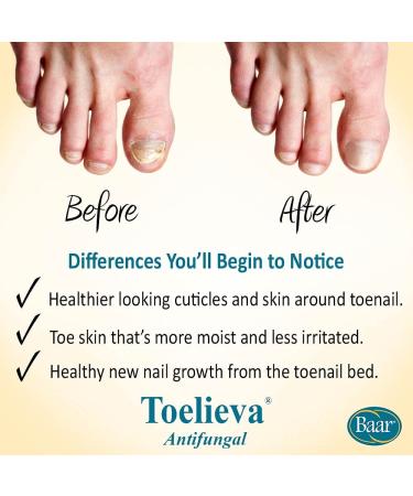 Toelieva Antifungal - Maximum Undecylenic Acid for Toe Nail Fungus - 2 oz - Buy Online on GoSupps.com