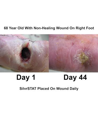 First Aid Kit Gel - 32 PPM Silver Healing Wound Dressing | SilverSol Ag O | 3 oz | International Shipping - Buy Online on GoSupps.com