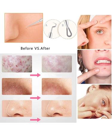 Musment 5PCS Blackhead Remover Pimple Tool Kit Acne Tools - Buy Online on GoSupps.com