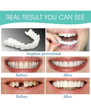 Buy Frenzify Comfortable Veneers - 2 Pairs of Top & Bottom False Teeth for Men & Women | Perfect Provisional Dentures for Missing Teeth - Buy Online on GoSupps.com