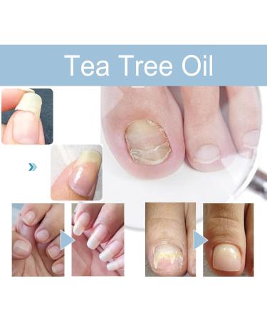 Onyxoguard Serum Onyxoguard Nail Growth and Repair Serum Onyxoguard Nail Serum Onyxoguard Nail Repair Serum Nail Growth and Strengthener Essence for Thin Nails and Growth (5PCS) - Buy Online on GoSupps.com