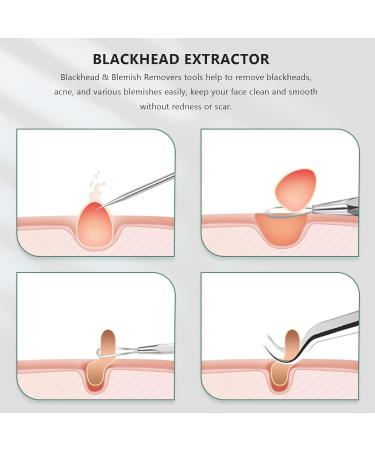 cogae Blackhead Remover Pimple Tool Kit Blackhead Extractor Tool Blemish Whitehead Popping Tool with Portable Metal Case - Buy Online on GoSupps.com