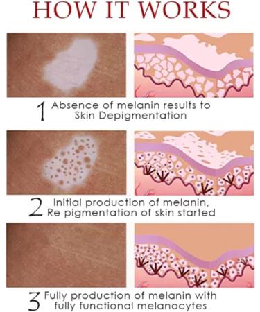 Vitiligo Removal Relief Spray | Skin Repair & Care | Reduces White Spots | Set of 5 - Buy Online on GoSupps.com