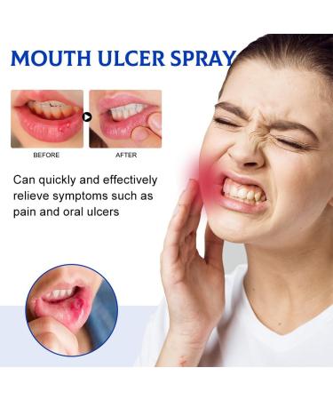 Mouth Ulcer Spray - 30ml Antibacterial Relief for Mouth Wounds & Soothing Care - Buy Online on GoSupps.com