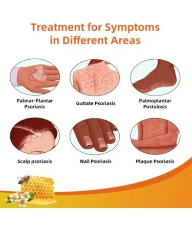 Cvreoz Bee Venom Psoriasis Cream | New Zealand Bee Venom Treatment for Psoriasis (1PC) - Fast International Shipping - Buy Online on GoSupps.com