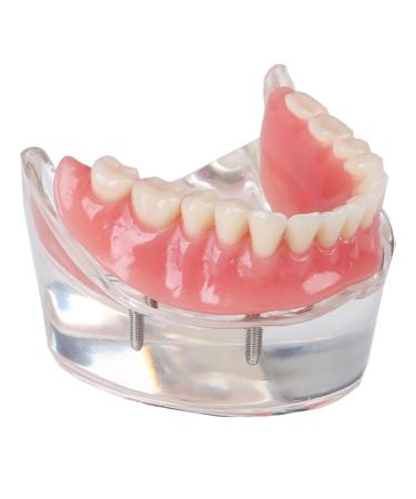Dental Upper Implantate Model - Upper Overdenture Restoration Model - With superior teeth demo transparent vision soft gum implant nail for education and study model (c)