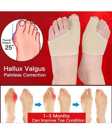 Bunion Corrector Splint Pads - Hallux Valgus Brace for Overlapping Toe - 2 Pair (BPA-Free) - Buy Online on GoSupps.com
