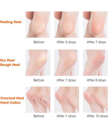 Nado Care Large Moisturizing Gel Socks for Dry Cracked Heels - 5 Pair Set - Buy Online on GoSupps.com