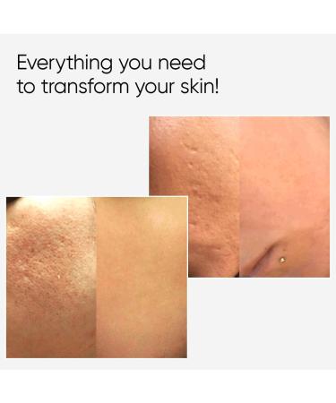 AME Pure CIT Face Roller - Microneedling Roller for Collagen Boost - Premium Quality Micro Needling Roller - Derma Roller 0.5mm - Derma Roller for Face That is Laser Treatment Alternative - Buy Online on GoSupps.com
