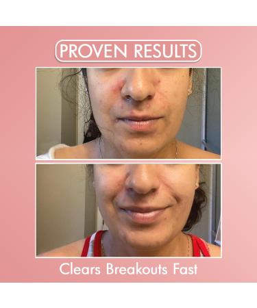 Bella V rit Saving Face | Salicylic Acid Acne Spot Treatment | Vegan & Talc-Free | Colloidal Sulfur & Zinc Oxide | 1 Fl Oz - Effective for Teens & Adults - Buy Online on GoSupps.com