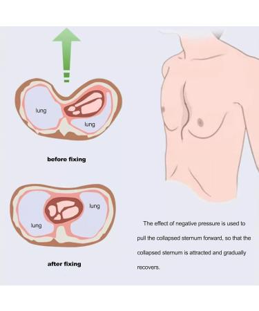 Vacuum Bell Pectus Excavatum Sternal Depression Support Thoracic Depression Brace Physical Correction Sunken Sternum Brace Real-Time Pressure Gauge Monitoring(Small) - Buy Online on GoSupps.com