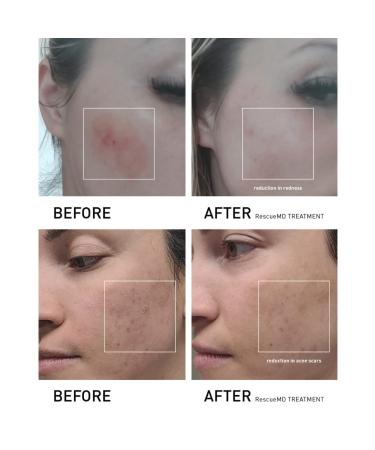 DNA Repair Complex PRO Scar Treatment Serum - Post-Procedure Skin Damage Solution 120ml | Fast International Shipping - Buy Online on GoSupps.com
