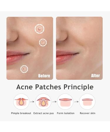 Ultra Pimple Patches - Hydrocolloid Acne Dots for Face | 96 Count | Day & Night Use for Zits & Blemishes - Buy Online on GoSupps.com
