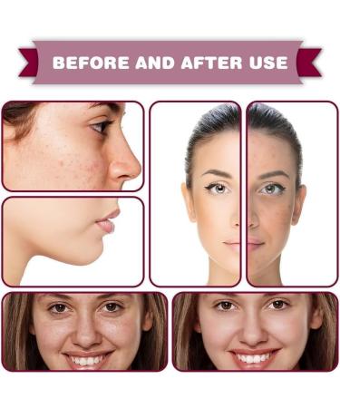 (100% 5 star) 4PCS Alpha Hydroxy Acid Serum Rosacea Facial Serum | Fruit Acid Serum for Reduce Redness | Rosacea Care Skin Care | for Face Redness Corrector | Balance Excess Sebum - 30ml - Buy Online on GoSupps.com