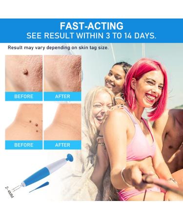 Skin Day Remover Kit - 40 Ligaments & 36 Repair Patches for Small to Medium Skin Tags - Buy Online on GoSupps.com