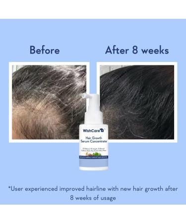WishCare Hair Growth Serum - 3% Redensyl 4% Anagain Caffeine & Biotin - Best Hair Growth Solution for Men & Women | International Shipping - Buy Online on GoSupps.com