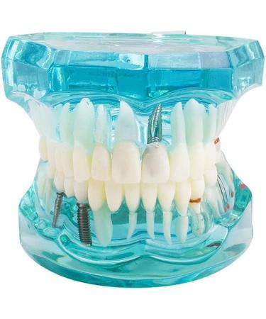 Buy Lmeil Transparent Dental Teeth Model - Ideal for Implantation & Dentist Research | Pathological Dental Model - Buy Online on GoSupps.com