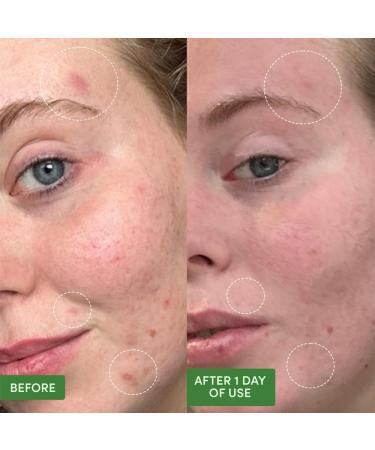 Sand & Sky Dual Action Blemish Patches - Hydrocolloid Acne Treatment with Salicylic Acid & Tea Tree Oil (75 Patches) - Reduce Redness & Inflammation - Buy Online on GoSupps.com