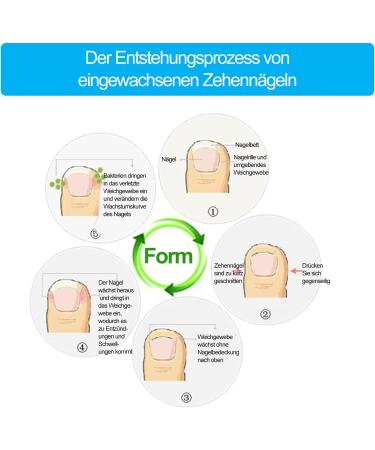 Ingrown Toenail Correction Patch - Glue-free Toe Nail File Paronychia Corrector - 4 Sizes - Foot Care Treatment Pedicure Tool - Buy Online on GoSupps.com