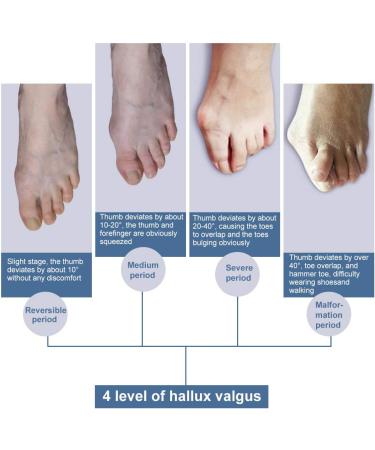 Bunion Corrector & Splints - Achieve Natural Alignment at Home for Men & Women - Buy Online on GoSupps.com