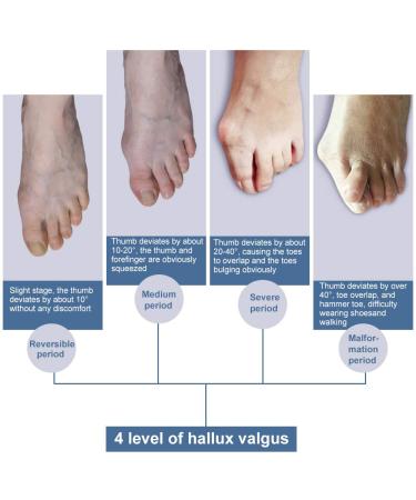 Hallux Valgus Correction - Adjustable Bunion Corrector & Toe Smoothing Relief for Left Foot - Buy Online on GoSupps.com