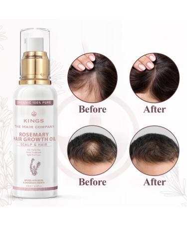 Kings 100% Natural Rosemary Oil for Hair Growth with Biotin - Promotes Hair Growth & Prevents Hair Loss Organic Rosemary Hair Oil to Treat Dry Damaged Hair for Men & Women | 100 ml - Buy Online on GoSupps.com
