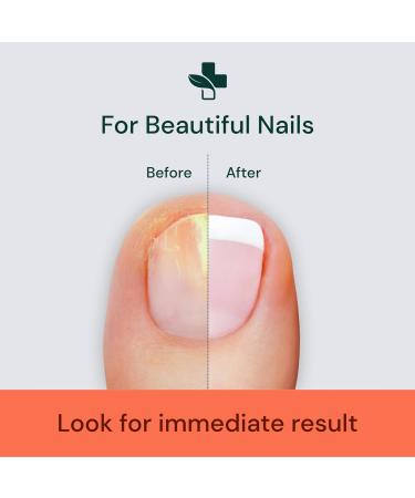YogaMedic Nail Fungus Pen - Patented Quick Treatment for Toenail Fungal Infections - Buy Online on GoSupps.com