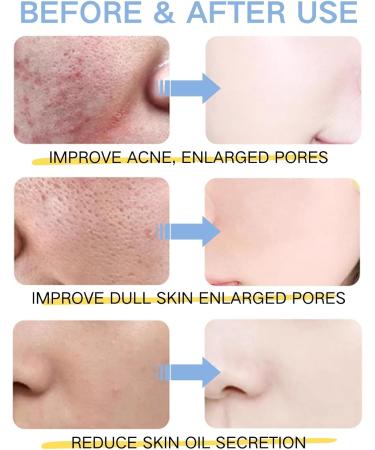 Salicylic Acid Skin Care Set - Skin Care Sets & Kits for Facial Cleanser Face Serum Face Cream - Anti-Aging & Anti-Wrinkle Skincare Set - Teenage Girls Gifts - Gifts for Teenage Girls - Skin Care - Buy Online on GoSupps.com