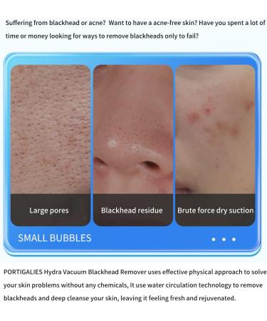 Portugalies Rechargeable Blackhead Remover Pore Vacuum - 3 Suction Modes, 6 Probes - Buy Online on GoSupps.com