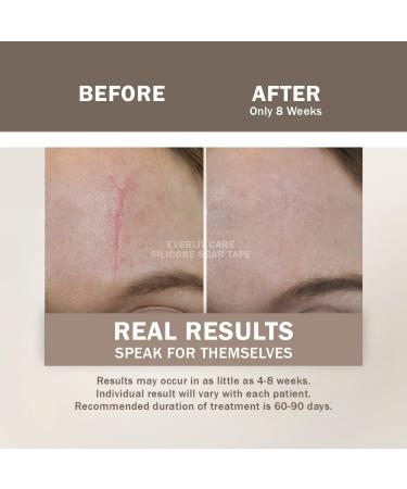 Everlit Silicone Scar Sheet | Medical Grade Skin Repair Strips for C-Section Acne Surgery | Soft Reusable Gel Tape | 1.6 x 60 Roll - Buy Online on GoSupps.com