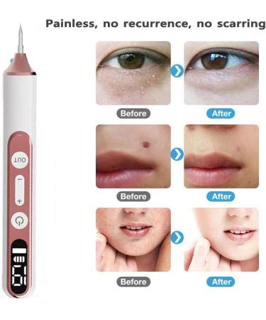 HpLNDas Plasma Pen Needle Set Skin Flap Removal Pen 19 Intensity Levels and LED Light with Replaceable Needle for Face Body Warts Freckles Nevus Age Spots - Buy Online on GoSupps.com