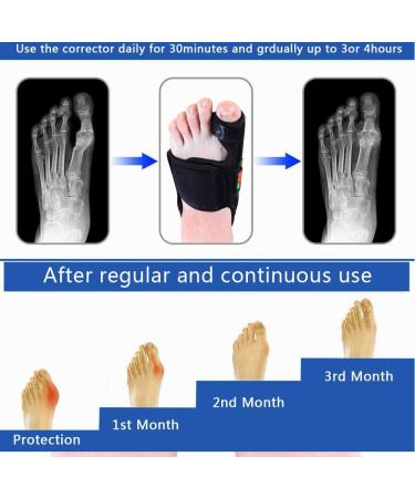 Adjustable Bunion Corrector - Orthopedic Hallux Valgus Device for Foot Comfort (Black M Code) - Buy Online on GoSupps.com