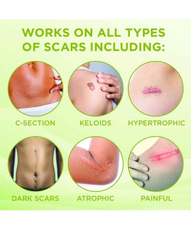KELODA Keloid Scar Care Butter Stick - Surgical Scars & Keloids Removal Balm with Cocoa & Shea Butter - For Stretch Marks, Acne, Piercings | Coconut & Jojoba Oils - Effective Anti-Scar Treatment - Buy Online on GoSupps.com