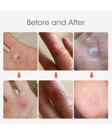 MQ 36 Pcs Corn Removal Pads for Foot Corn, Toe Corn, Callus Removal - Stops Wart Regrowth & Provides Pain Relief - Foot Care (36 Count) - Buy Online on GoSupps.com