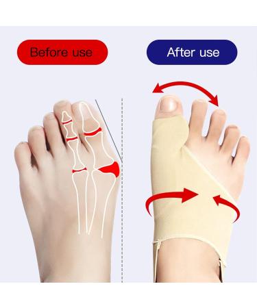 Gel Metatarsal Pad for Bunions - Pain Relief & Toe Alignment - Correct Crooked Toes & Overlap - Hallux Valgus Support - Buy Online on GoSupps.com