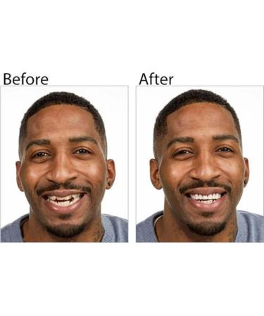 2 Pairs Regain Confidence Smile for Women and Men Temporarily Adjustable (S) 1 Count (Pack of 1) - Buy Online on GoSupps.com