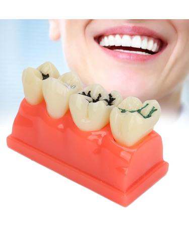 Ververt Touch Tooth Model - 180mm Dental Caries Demonstration Model for Schools & Dentists | Learning Aid for Dental Lessons - Buy Online on GoSupps.com