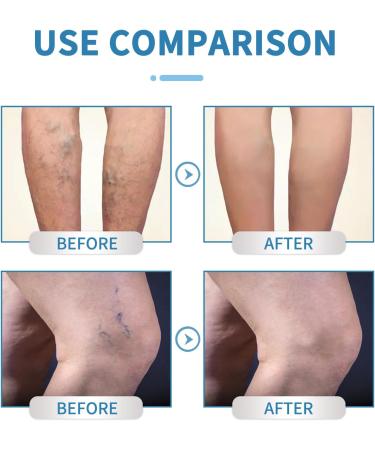 Shantou Youjia Variant Veins Spray Cream against spider veins and vein care fade cream spray against spider vein for radiant skin Skin Revealing and Care for Varicose Veins Location care spray 30 ml - Buy Online on GoSupps.com