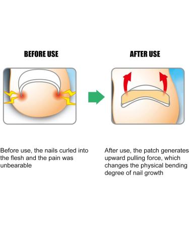 Ingrown Toenail Correction Fixer 13pcs Patch for Manicure Care Pedicure Tools - Buy Online on GoSupps.com