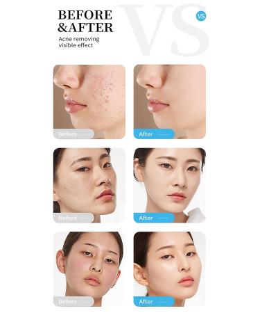 Easilydays Mango Acne Cream: Pimple & Scar Treatment for Moisturized Skin, Pore Reduction & Acne Scar Removal - Balances Water & Oil - Buy Online on GoSupps.com