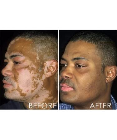 DUBUSH Vitiligo & Psoriasis Relief Spray - Skin Repair Treatment for Reducing White Spots - Soothing & Moisturizing Formula - 1 Pcs - Buy Online on GoSupps.com