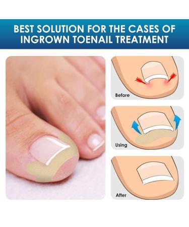 Ingrown Toenail Treatment - 100Pcs Breathable Corrector Patches & Strips | Pain-Free Nail Correction Durable Light Brown Stickers for Effective Ingrown Nail Care - Buy Online on GoSupps.com