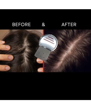 EasyHealth Lice Comb - (1 Pack) Effective Lice Removal Tool - Buy Online on GoSupps.com