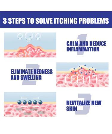 Chirsfairy Psoriasis Relief Treatment Spray 30ml - Soothes Itching, Gentle Skin Hand Foot Relief - 3PCS - Buy Online on GoSupps.com