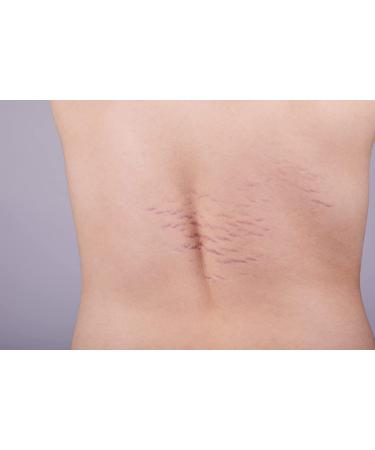LURE Essentials Fade Stretch Marks Cream with Cocoa Butter - Pregnancy Stretch Mark Remover & Prevention - Buy Online on GoSupps.com
