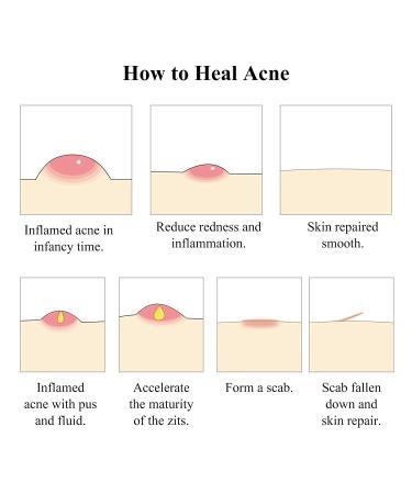 Tea Tree Acne Treatment Serum - Clear Severe Acne Breakouts & Repair Skin - 40ml (1.41fl oz) - Buy Online on GoSupps.com